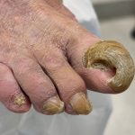 Deforme Tırnak Bakımı